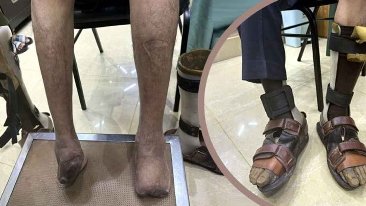 দেবী শেঠীর কাছে চিকিৎসা নিয়ে পা হারানোর ঘটনা